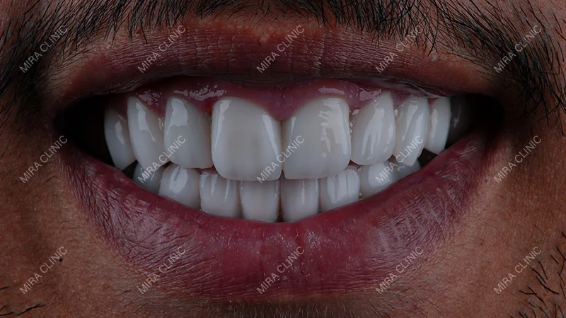 crowns and bridge changed the teeth physically